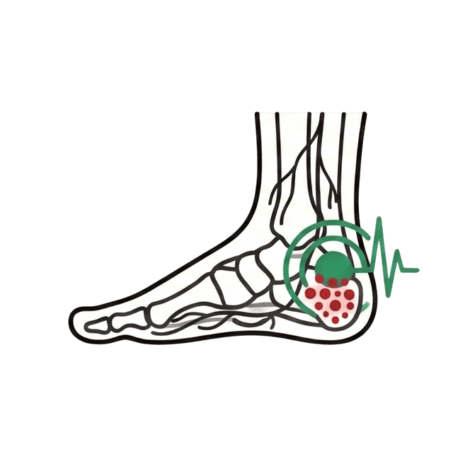 Heel pain
